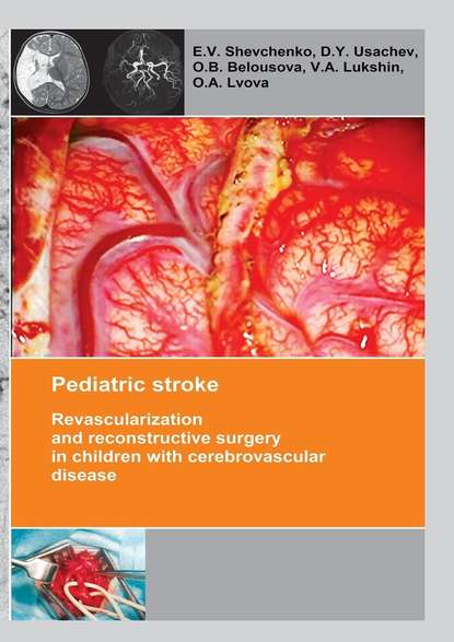 Pediatric stroke. Revascularization and reconstructive surgery in children with cerebrovascular disease (E. V. Shevchenko). 