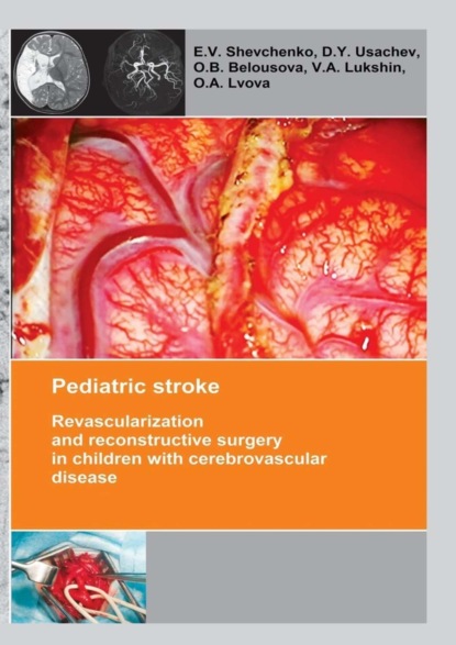 Pediatric stroke. Revascularization and reconstructive surgery in children with cerebrovascular disease - E. V. Shevchenko