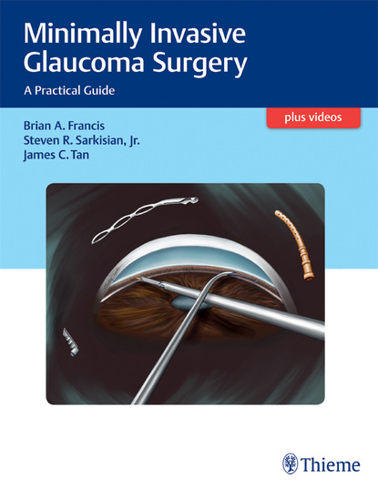 James C. Tan - Minimally Invasive Glaucoma Surgery