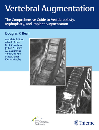 Douglas P. Beall - Vertebral Augmentation