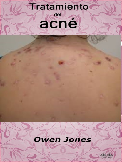 Owen Jones - Tratamiento Del Acné