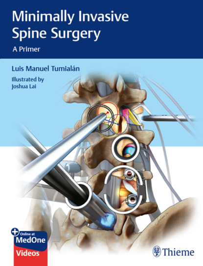 Luis Manuel Tumialan - Minimally Invasive Spine Surgery