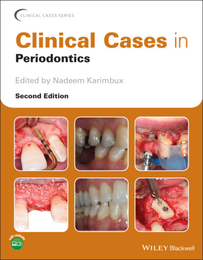 Clinical Cases in Periodontics